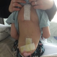 operacija hrbtenice, 6-letni deček, 3d printer