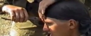 VIDEO: S kleščami potegnili naboj iz čela