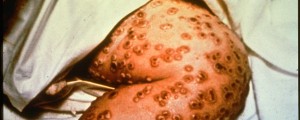 Jugoslovanska epidemija – najhujše biološko orožje