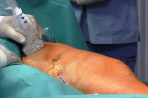 VIDEO: V živo z operacije žil pri dr. Šikovcu
