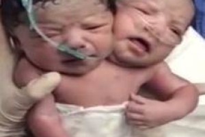 VIDEO: Siamska dvojčka umrla še pred poskusom ločitve