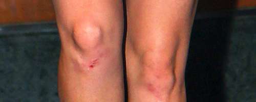 FOTO: Kaj je razlog za obtolčena kolena slavne plavolaske?