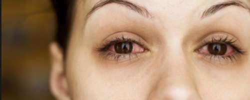 Imate zaradi alergije rdeče in solzne oči?