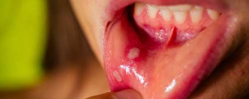 Ko se v ustih pojavijo boleče in nadležne afte