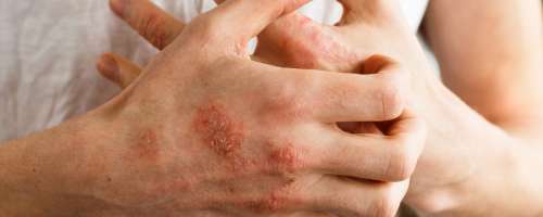 Atopijski dermatitis je več kot kožna bolezen