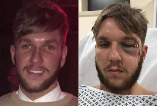 Jack-Wheats-injuries-after-playing-for-Goole-AFC-main