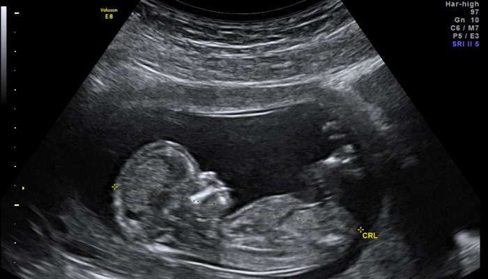 ultrazvok nosecnost