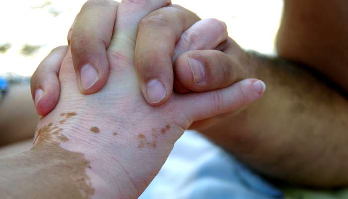 vitiligo, roke