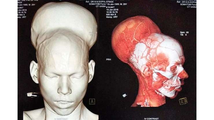 Indijcu odstranili možganski tumor, velik skoraj kot še ena glava