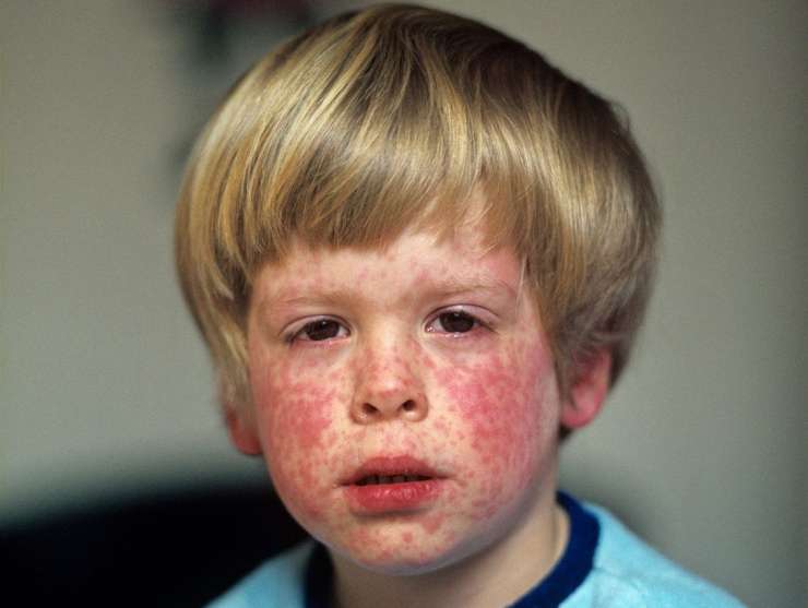 In northern Macedonia, a measles epidemic has been declared