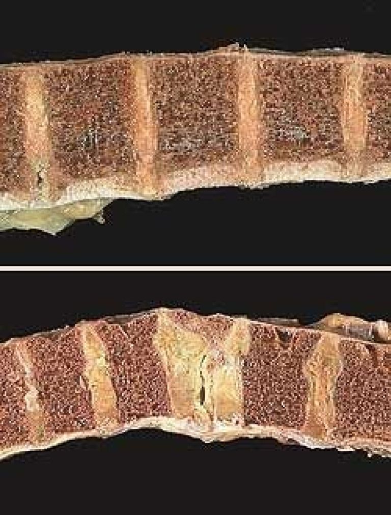 osteoporoza.jpg