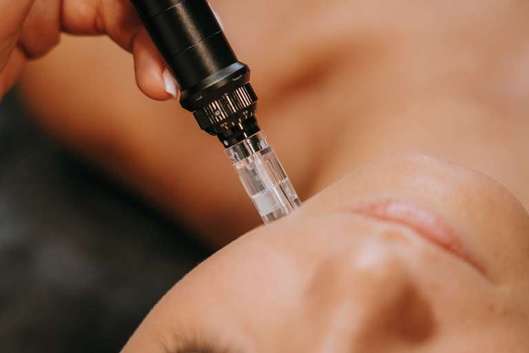 microneedling obraz .jpg