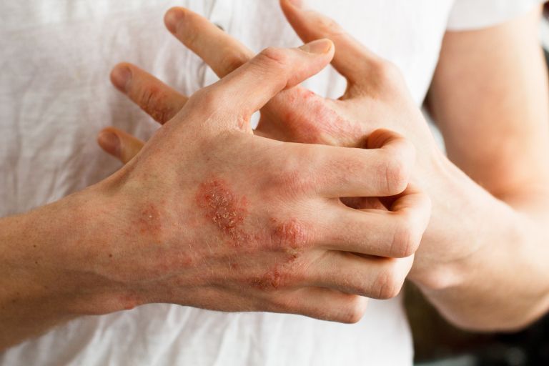 atopijski-dermatitis