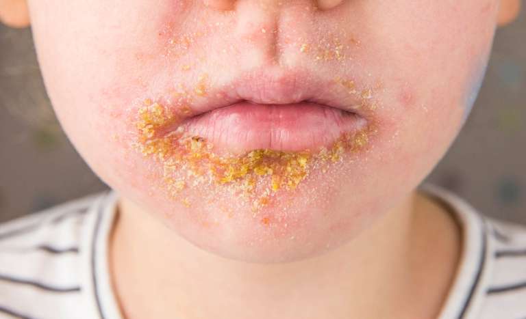 impetigo (1).jpg