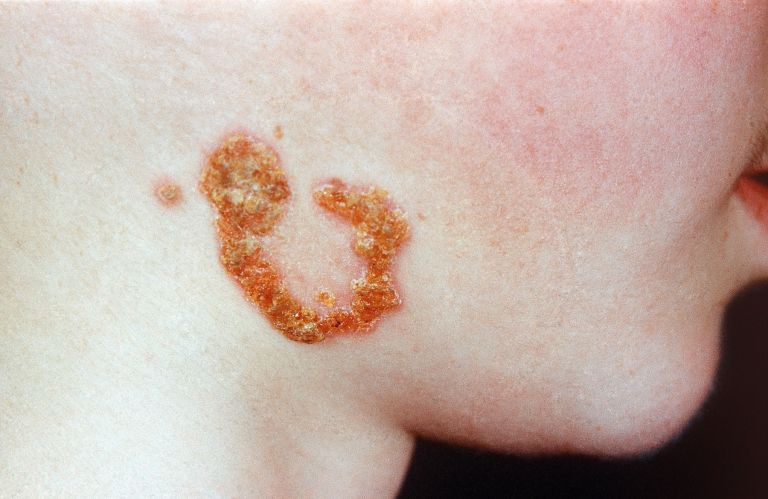 impetigo (2).jpg