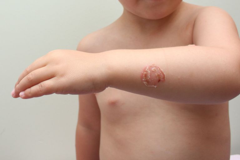 impetigo.jpg
