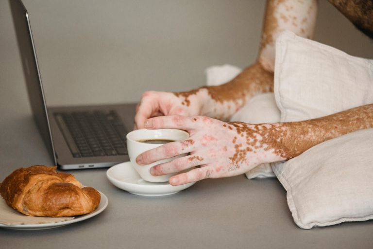 vitiligo