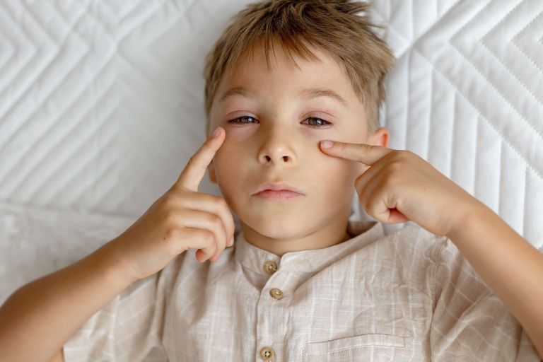konjunktivitis
