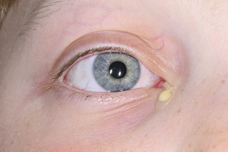 konjunktivitis