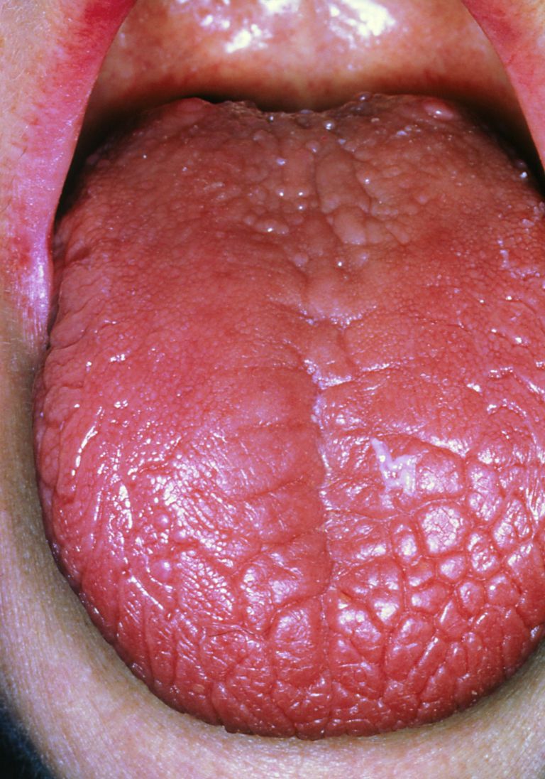 sjogrenov-sindrom