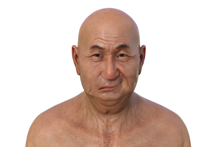 mozganska-kap