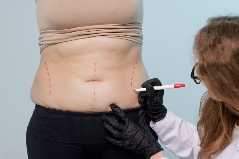 liposukcija