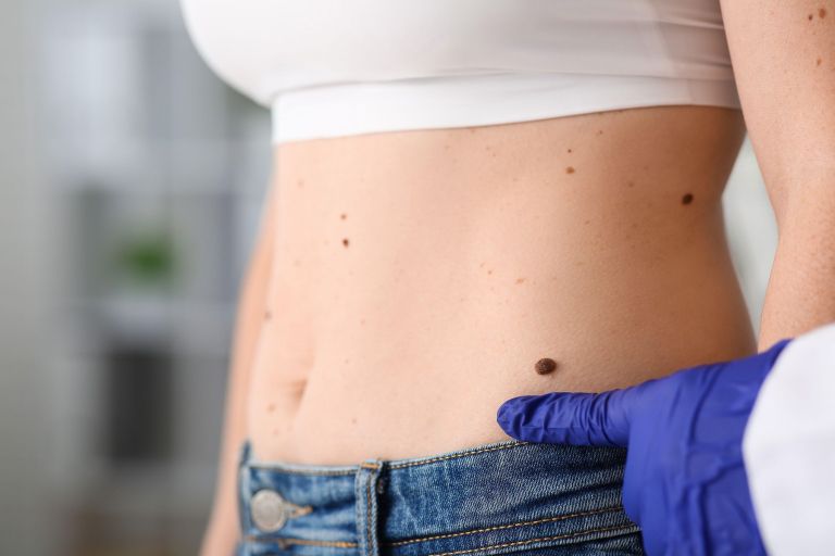 dermatolog, pregled, zdravnik, znamenje