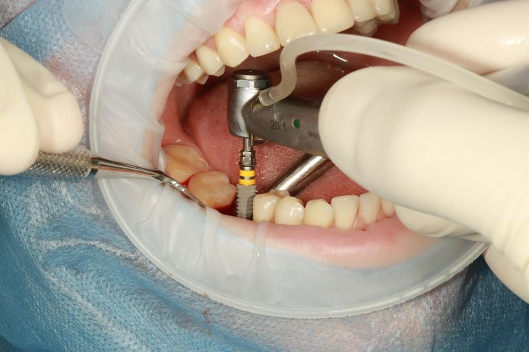 implantat