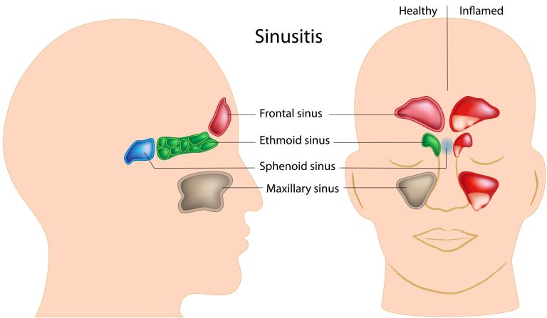 sinusitis, vnetje sinusov