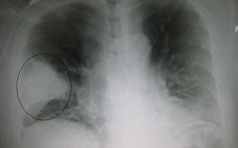 PneumonisWedge09.JPG