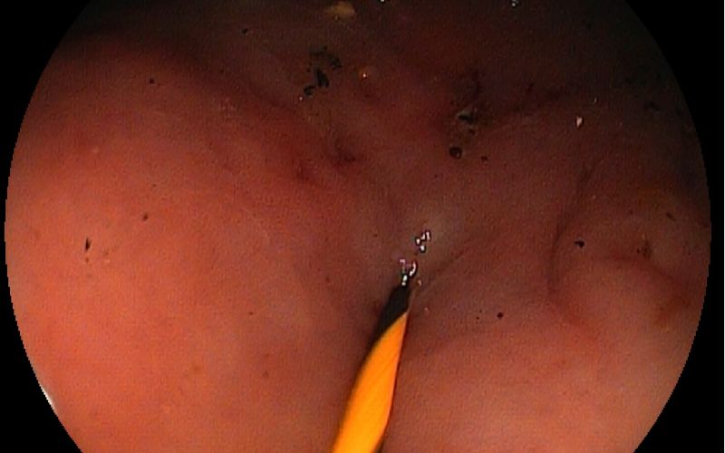 endoskopija vagina