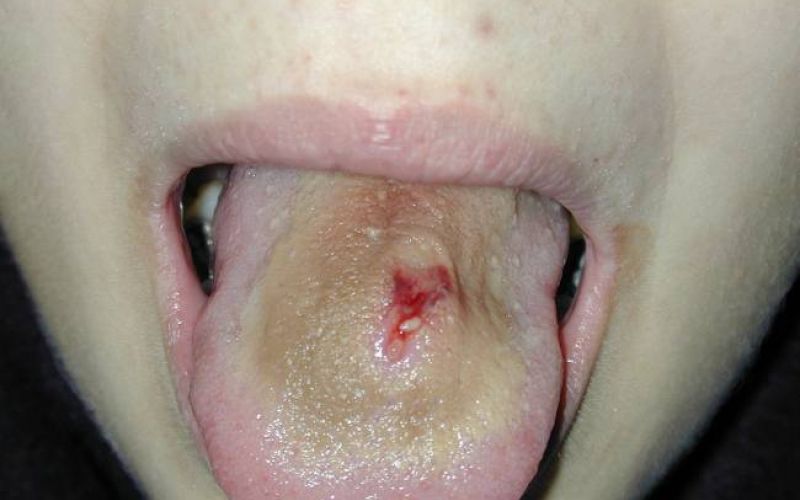 jezik strela piercing