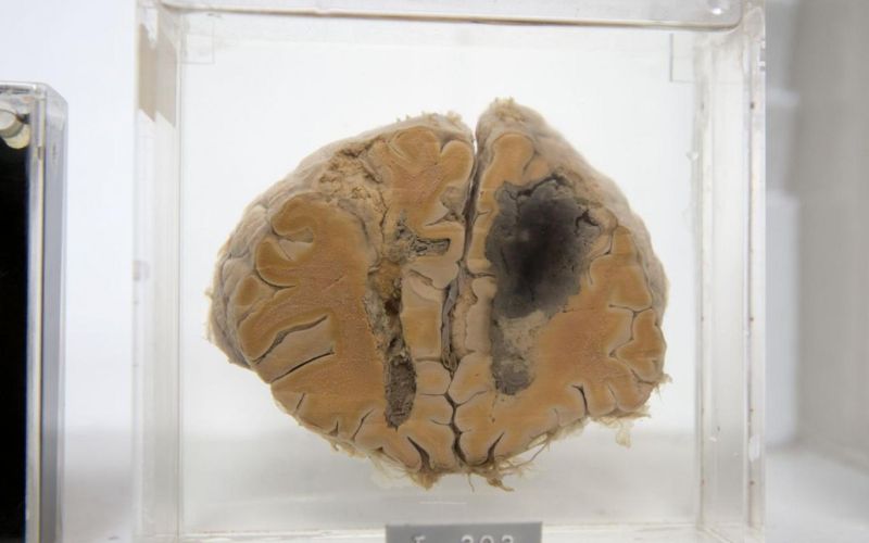 Lobotomised-Brain.jpg