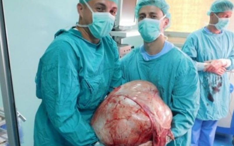 kirurgi odstranili tumor 31 kilogramov Banka Luka.jpg