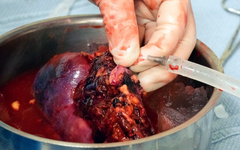 ledvica, presaditev, transplantacija, kirurgija