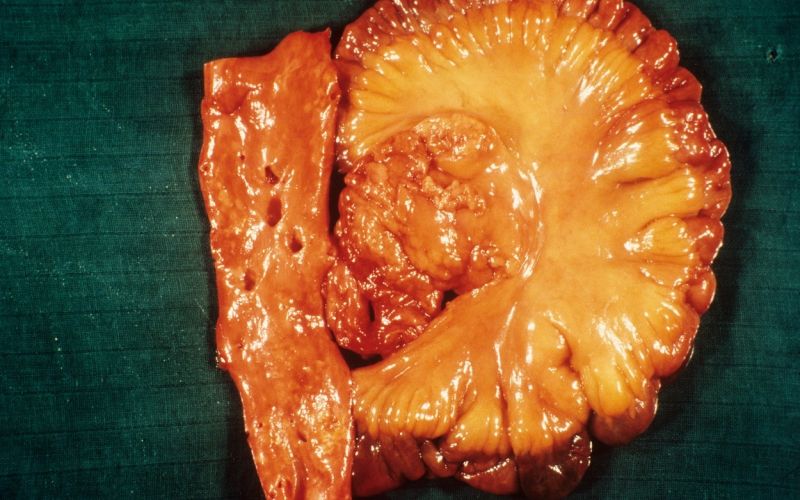 mezenterij, trebuh, aorta