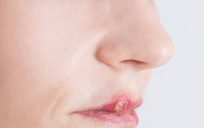 herpes.jpg