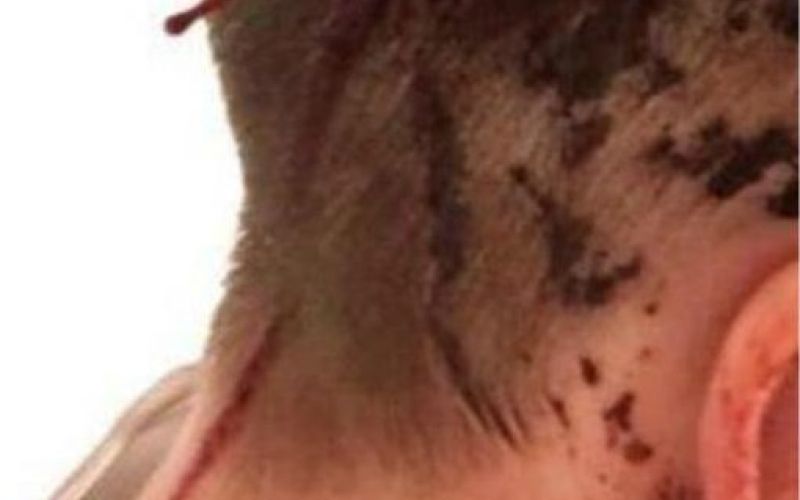 grosskreutz poskodba.jpg