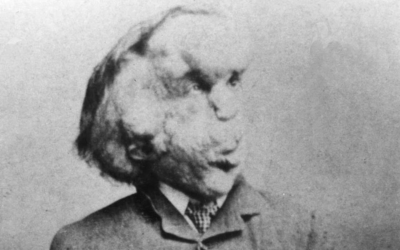 Joseph Merrick, človek slon