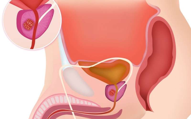 rak prostate.jpg