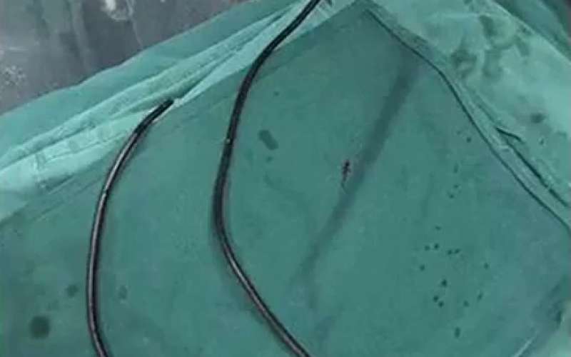kabel, penis, operacija