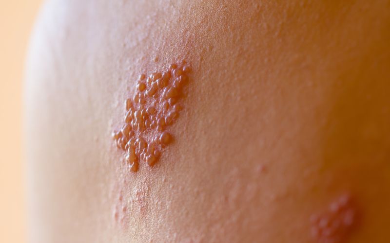 herpes2.jpg