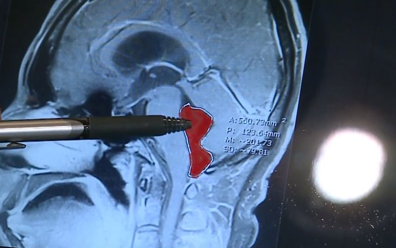 trakulja, mri