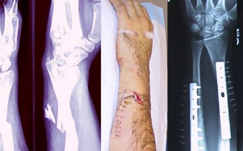 Broken_fixed_arm.jpg