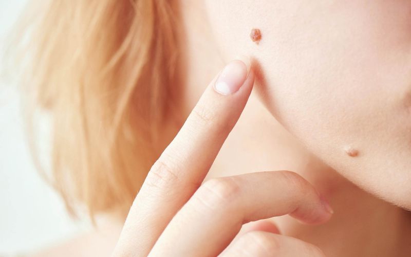 z znamenja benigno melanocitno znamenje.jpg