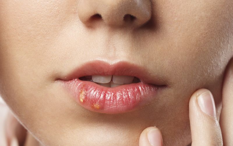 herpes, sonce
