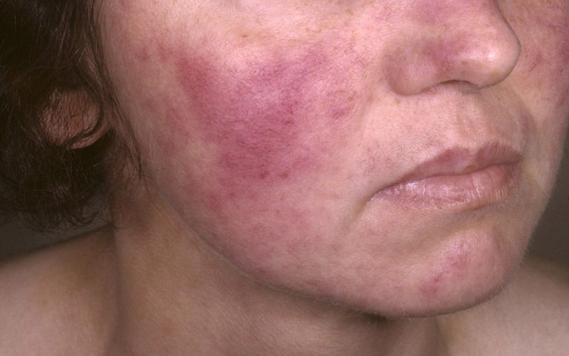 lupus, izpuščaj na obrazu