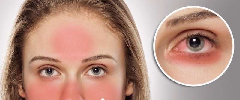 Simptomi: očesne veznice so močno pordele, bolnik je v obraz rdeč, kot bi bil opečen po sončenju.
