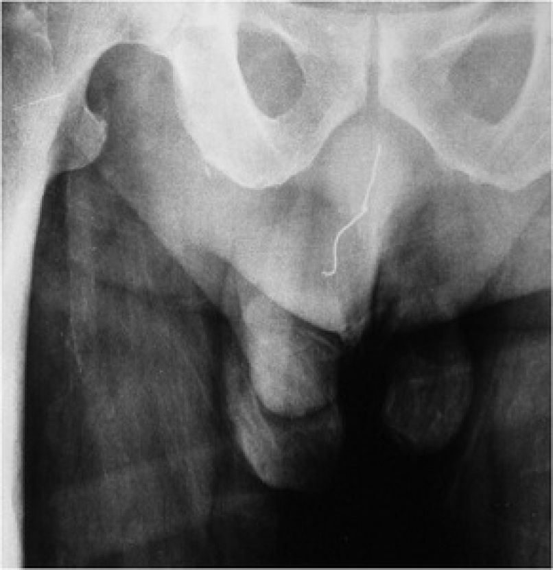 penis