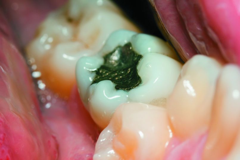 amalgam
